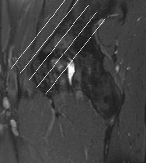 athletic pubalgia ax