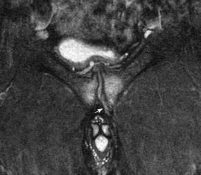 athletic pubalgia cor